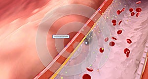 Damage to the endothelium, cholesterol, fats, calcium, and tobacco residue can cause excess waste to become trapped in the artery