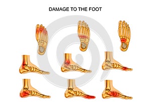 Damage to the foot