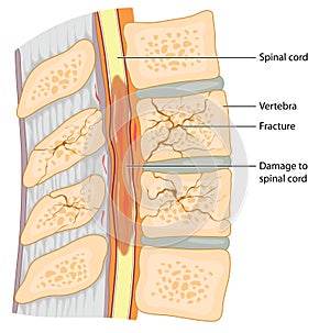 Damage to spinal cord due to vertebral fracture