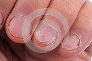 Damaged and bitten fingernails close-up