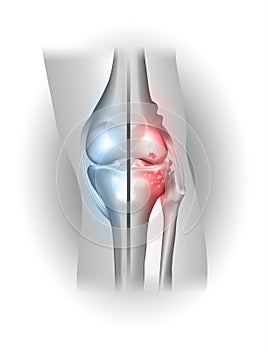 Damaged and healthy joint design