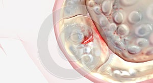 Damaged and malfunctioning mitral valve