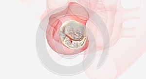 Damaged and malfunctioning mitral valve