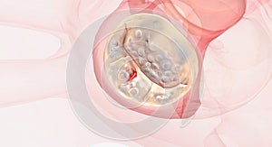 Damaged and malfunctioning mitral valve