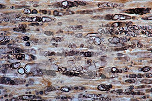 Damaged myelinated fibers. Wallerian degeneration