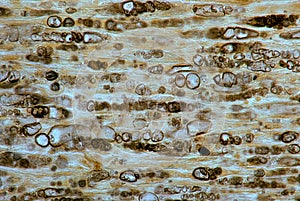 Damaged myelinated fibers. Wallerian degeneration