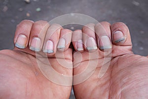 damaged nail without manicure with dirt close-up. Nail Health Care.