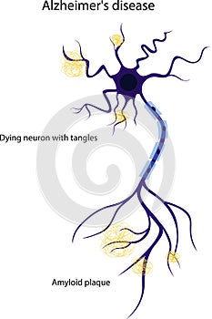 Damaged neuron. The structure of a diseased neuron. Alzheimers disease. Brain disease dementia, memory disorders.