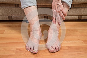 Damaged toes and wrinkled hand