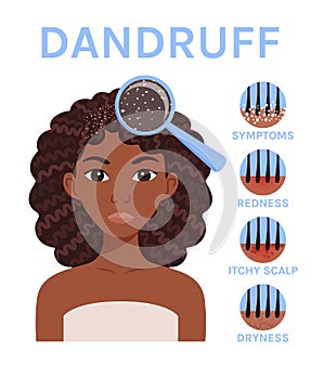 Dandruff. Beautiful Afro Woman with a Problem Scalp. Magnifying Glass and Close Up. Redness Itchy and Dryness. Cartoon style.