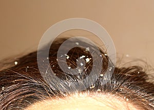 Dandruff on the hair. Hair disease seborrhea. Fatty Dandruff.