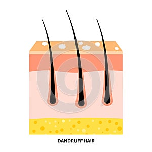 Dandruff hair poster