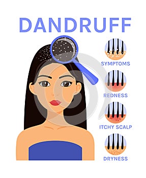 Dandruff on Hair. Scalp Disease and Beautiful Woman. Magnifying Blass and Close up view of Dandruff. Icons of Symptoms: Dryness,