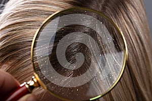 Dandruff In Hair Seen Through Magnifying Glass