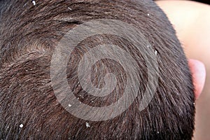 Dandruff in the hair