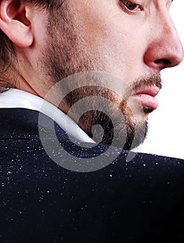 Dandruff issue on man's sholder