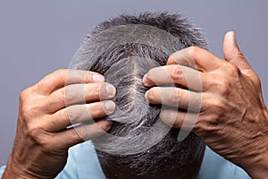 Dandruff On Man`s Hair