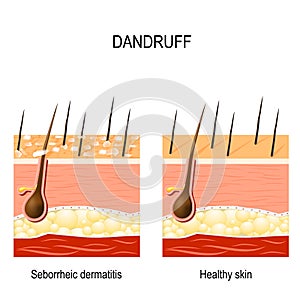 Dandruff. seborrheic dermatitis