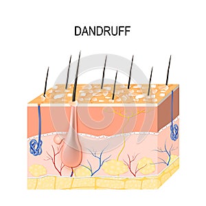 Dandruff. seborrheic dermatitis photo