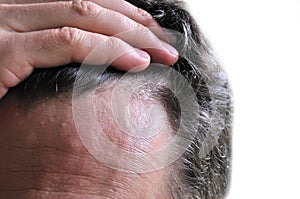 Dandruff skin issue photo