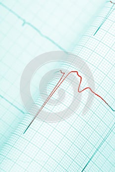 Dangerous symptoms on cardiogram