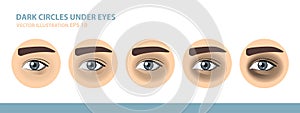 Dark Circles Under Eyes. Male Eye. Vector Illustration photo