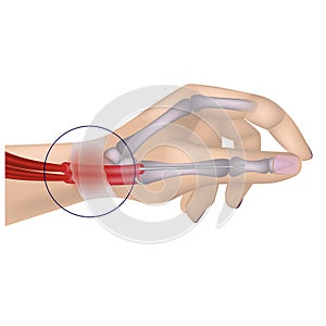 De Quervain disease. Occupational disease of the hand.