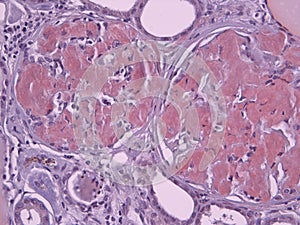 Histopathology of a Kidney with Amyloid deposits photo