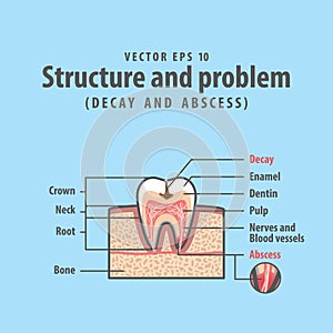 Decay and abscess cross-section structure inside tooth