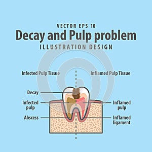 Decay and Pulp problem cross-section structure inside tooth