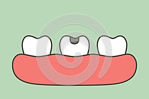 Decay tooth or dental caries