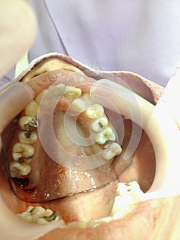 Decayed teeth check-up