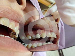 Decayed teeth check-up