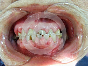 Decayed teeth check-up