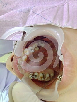 Decayed teeth check-up