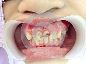 Decayed teeth check-up