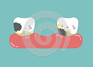 Decayed teeth ,teeth and tooth concept of dental