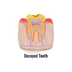 Decayed Tooth Poster