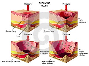 Decubitus ulcer photo