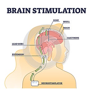 Deep brain stimulation procedure educational explanation outline diagram