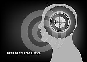 Deep brain stimulation surgery for Parkinson`s disease