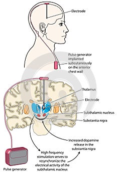 Deep brain stimulation photo