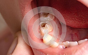 Deep caries in children on milk teeth. Treatment of caries, toothache. Baby teeth, macro
