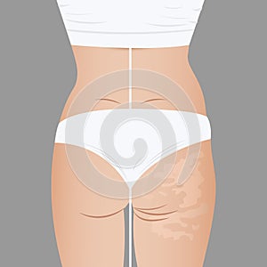Deep cellulite reduction Body contouring Lifting with . Physiotherapy, lymphatic drainage photo
