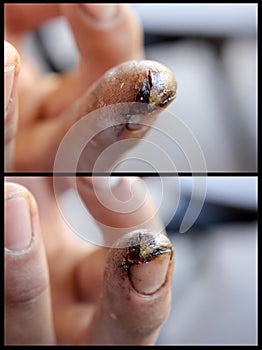 Deep Finger cut from a Power saw