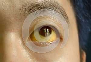 Deep jaundice in Asian male patient. Yellowish discoloration of skin and sclera. Hyperbilirubinemia