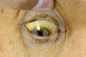 Deep jaundice in Asian male patient. Yellowish discoloration of skin and sclera. Hyperbilirubinemia