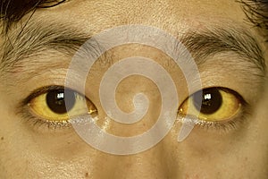 Deep jaundice in Asian male patient. Yellowish discoloration of skin and sclera. Hyperbilirubinemia