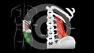 Deep and superficial trigger points in the quadratus lumbar muscle and reflected pain.