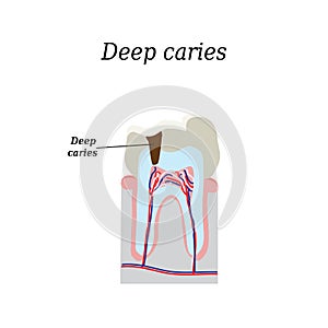 Deep tooth decay. Vector illustration on